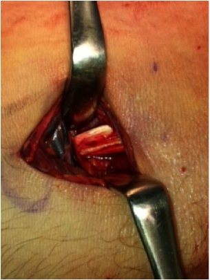 Distal Biceps Repair Final